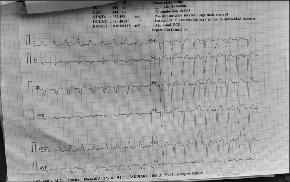 ECG showing left bundle branch block pattern.