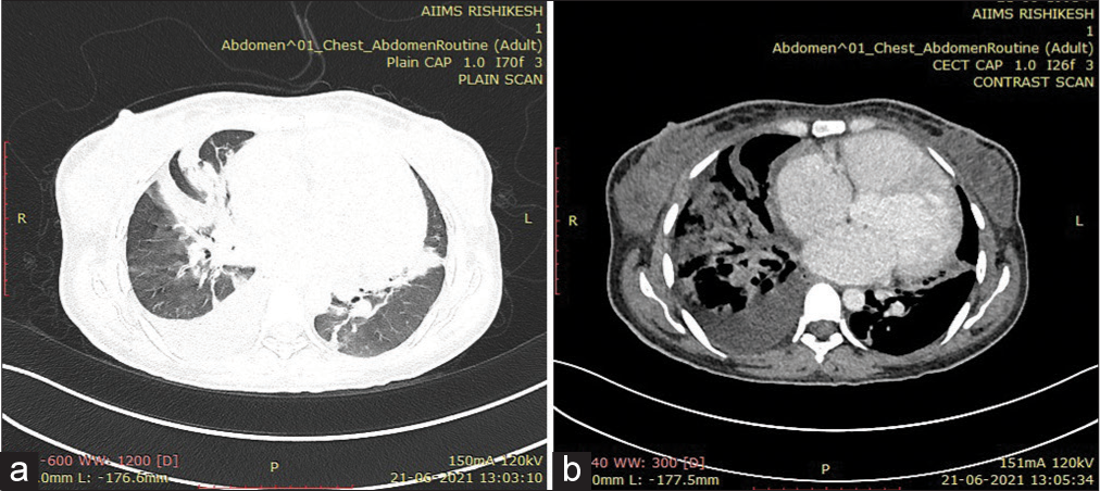 (a) HRCT chest image showing confluent areas of consolidation. (b) CECT chest image showing cardiomegaly with necrotic mediastinal lymphadenopathy and mild pleural effusion.