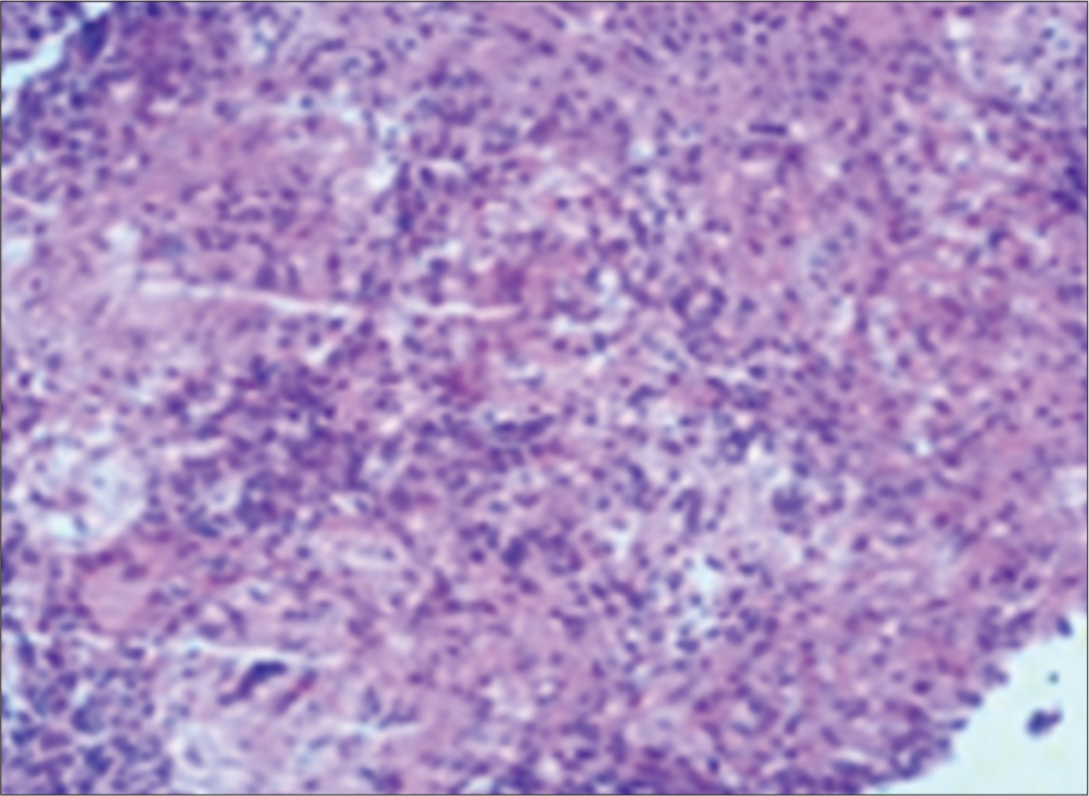 Gastric biopsy: Chronic granulomatous inflammation and ulcer formation were observed in the focal area of gastric mucosa under microscope, a small number of epithelioid cells and nodules formed by the aggregation of Langerhan’s giant cells in the mucosa, accompanied by more lymphocytes, a few plasma cells, eosinophils, neutrophil infiltration, and formation of lymphoid follicles (×100).