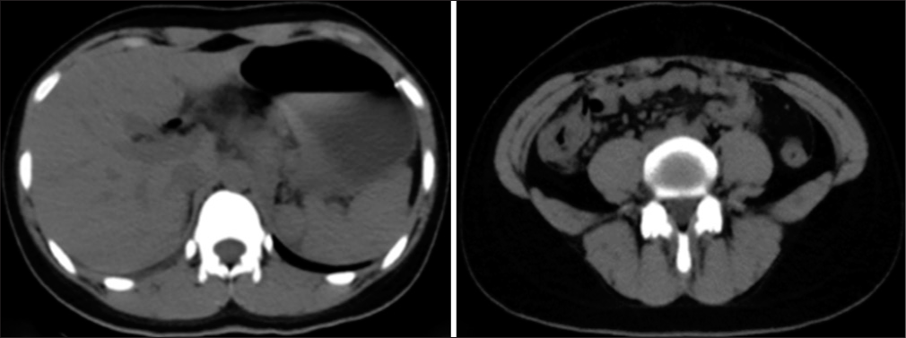 The gastric wall on the lesser curvature of the stomach was thickened, a small amount of fluid was accmulated in the hepatogastric space, and the lymph nodes in the hepatogastric space and retroperitoneum increased and enlarged; there was fluid in the pelvic cavity; the intrahepatic bile duct had stones or calcifications.