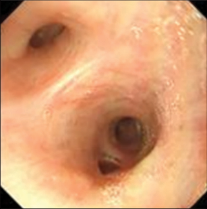 Bilateral bronchoscopy showed no obvious abnormalities.