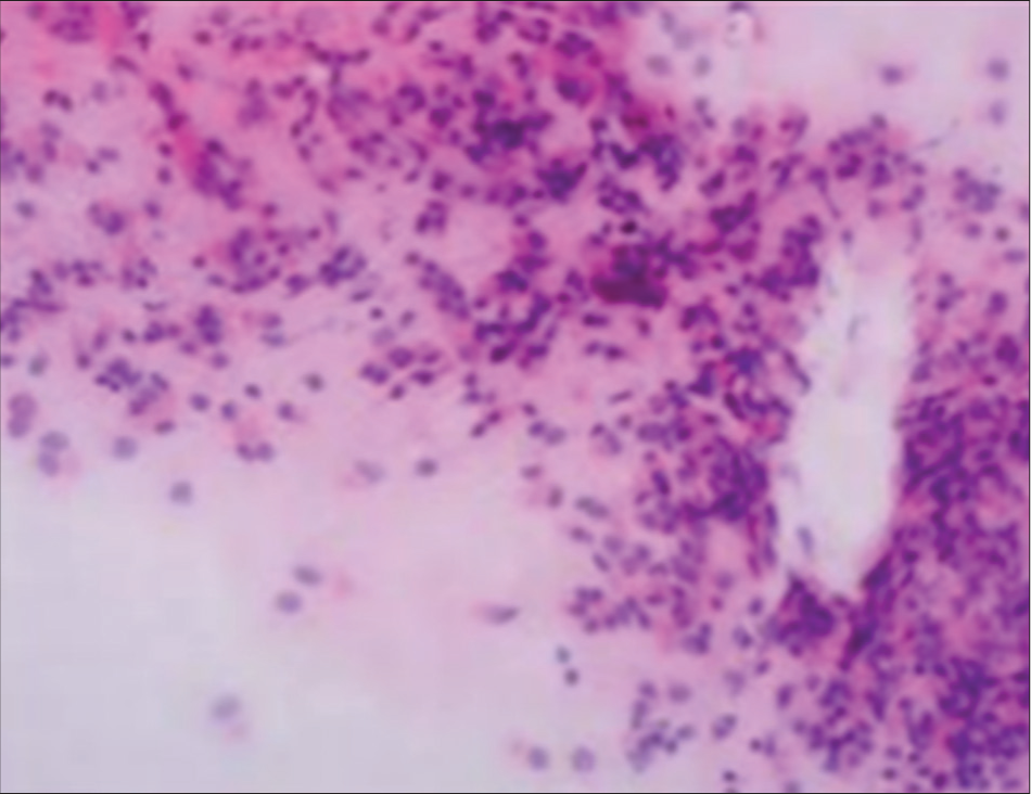 The brush film of the posterior basal segment of the right lower lobe showed more columnar epithelial cells and no malignant tumor cells (×100).