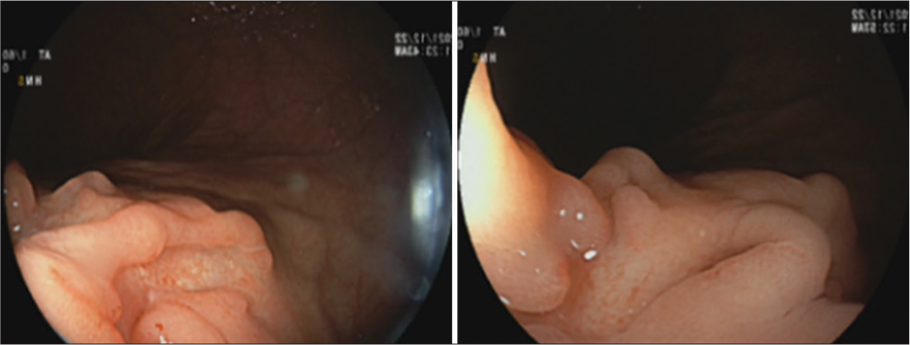 Multiple polyps of gastric body.