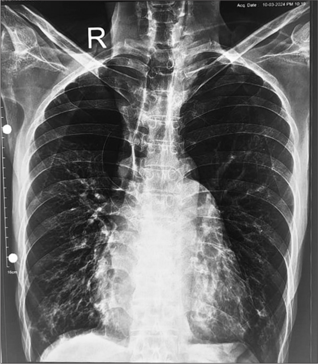 Chest X-ray showing multiple bullae in the bilateral upper lobe.