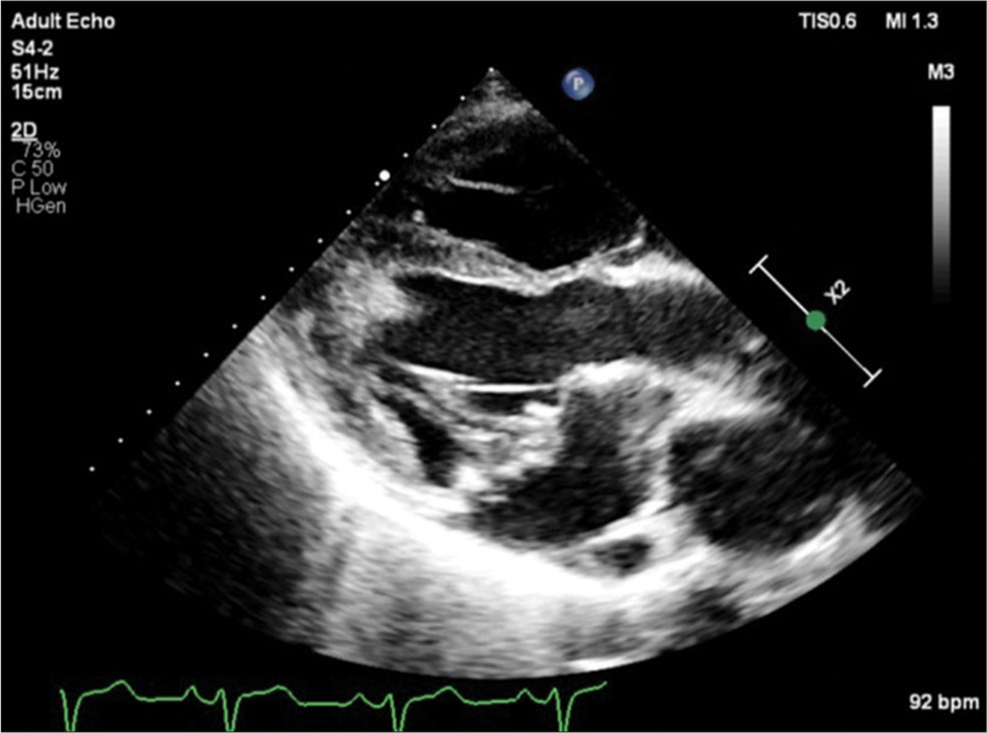 Transthoracic echocardiogram parasternal long axis view showing mitral valve prolapse. P: Echocardiography probe orientation, X2: Two times magnified view.