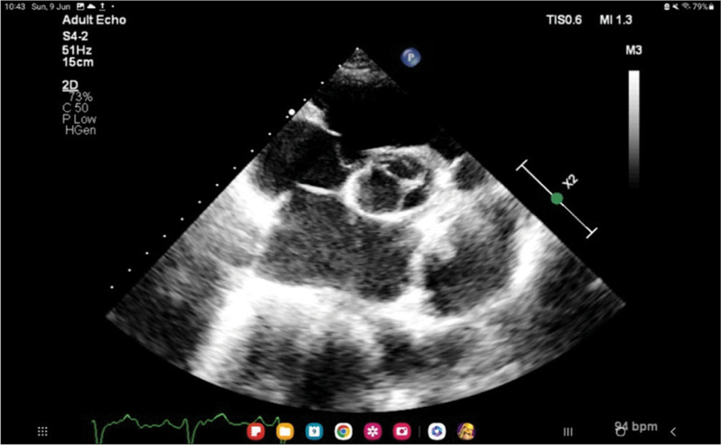 Transthoracic echocardiogram parasternal short-axis view showing tricuspid valve prolapse. P: Echocardiography probe orientation, X2: Two times magnified view.