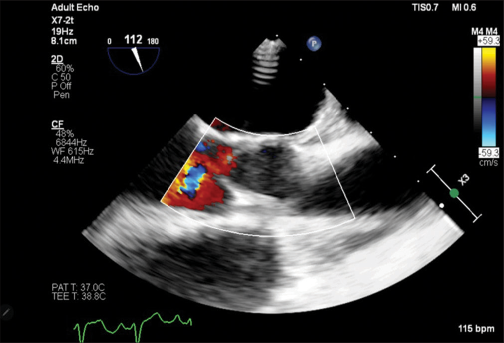 Transesophageal echocardiography image showing aortic valve prolapse with aortic regurgitation. Colour flow imaging showing turbulent flow with mild regurgitant jet from prolapsed aortic valve. P: Echocardiography probe orientation, X3: Three times magnified view.