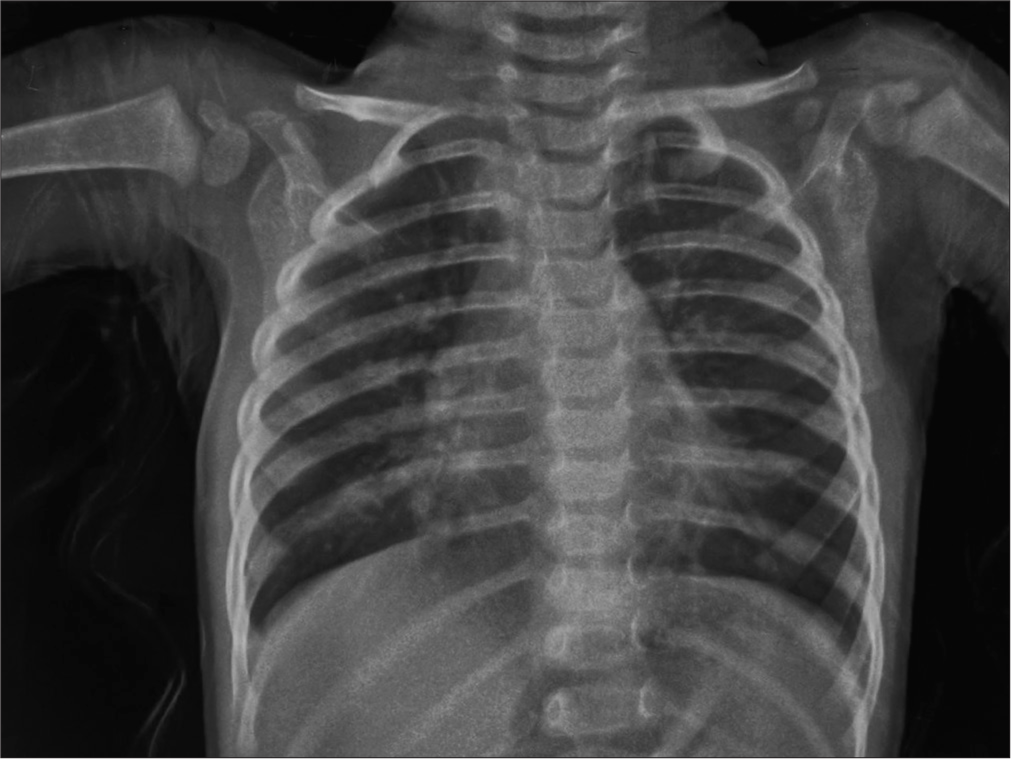 Chest X-ray posteroanterior view showing peribronchial opacities suggestive of microaspirations.