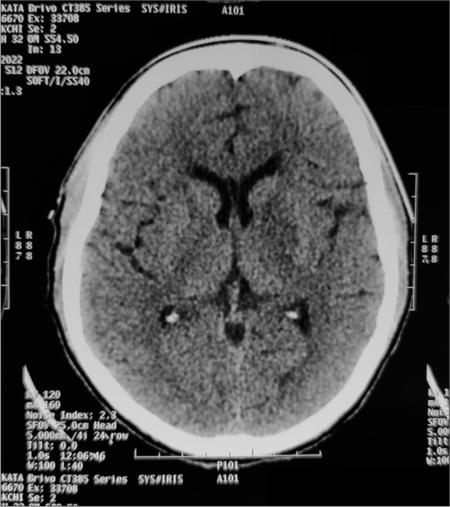 Computed tomography brain during the recurrence showing near-complete resolution of the previous findings.