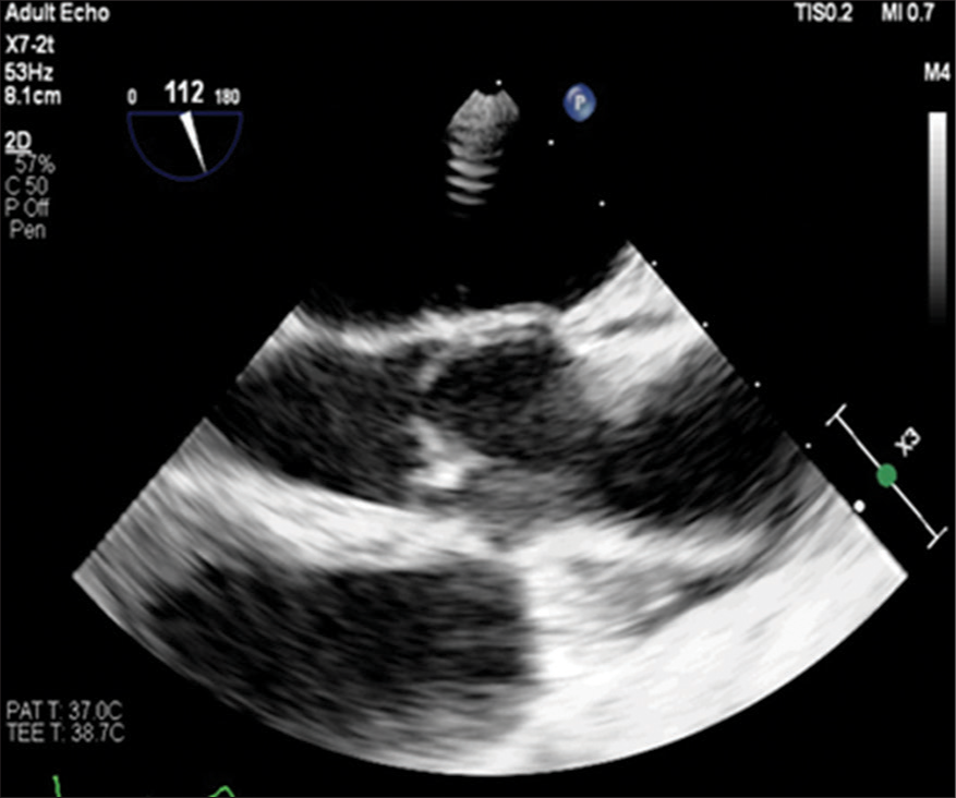 Transesophageal echocardiography image showing aortic valve prolapse. P: Echocardiography probe orientation, X3: Three times magnified view.